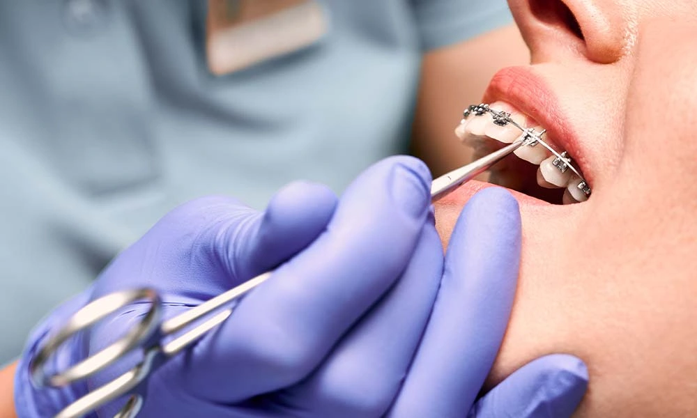 Where to Get the Best Dental Implants in Smyrna, GA